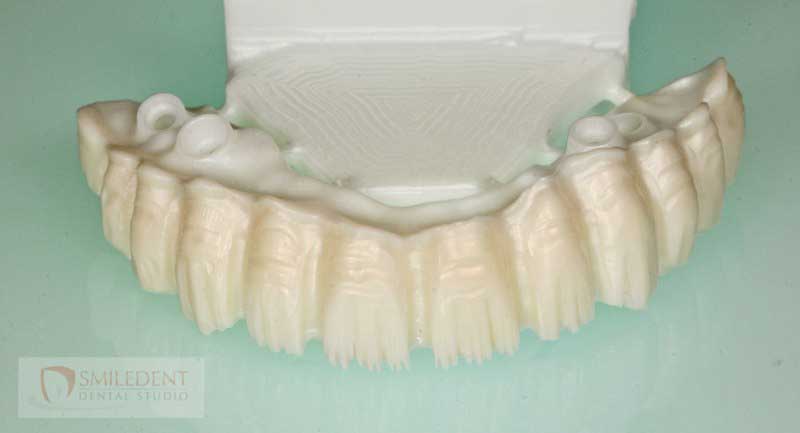 SmileDent Dental Studio | Prettau Bridge, Aesthetic E-Max Solutions and PFM AND FCM Solutions