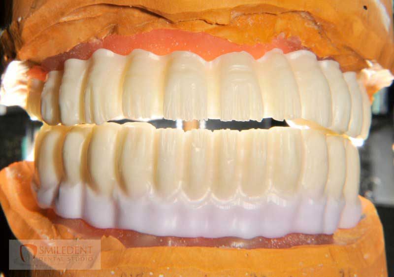 SmileDent Dental Studio | Acrylic Hybrid Solutions, CHROME trade  GuidedSMILE trade  and nSequence reg  Protocol 