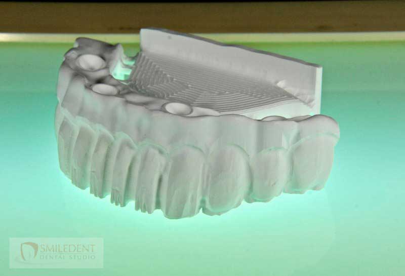 SmileDent Dental Studio | CHROME trade  GuidedSMILE trade , Acrylic Hybrid Solutions and nSequence reg  Protocol 