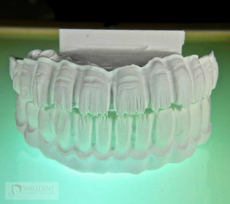 SmileDent Dental Studio | nSequence reg  Protocol , PFM AND FCM Solutions and Prettau Bridge