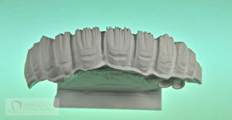 SmileDent Dental Studio | Acrylic Hybrid Solutions, Aesthetic E-Max Solutions and Implant Solutions