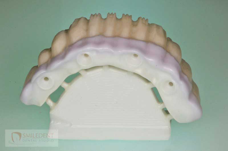 SmileDent Dental Studio | Zirconia, Aesthetic E-Max Solutions and Implant Solutions