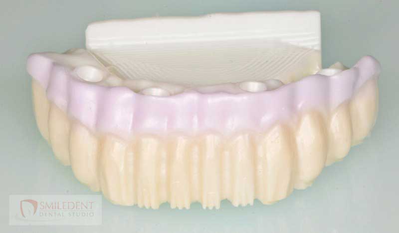SmileDent Dental Studio | Implant Solutions, Surgical Guides and Aesthetic E-Max Solutions