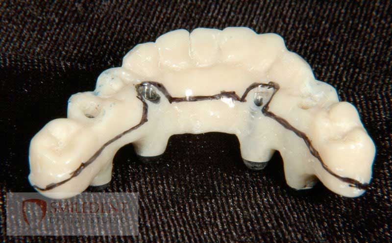 SmileDent Dental Studio | nSequence reg  Protocol , CHROME trade  GuidedSMILE trade  and Prettau Bridge