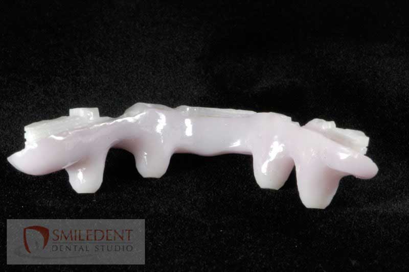 SmileDent Dental Studio | PFM AND FCM Solutions, Aesthetic E-Max Solutions and Surgical Guides