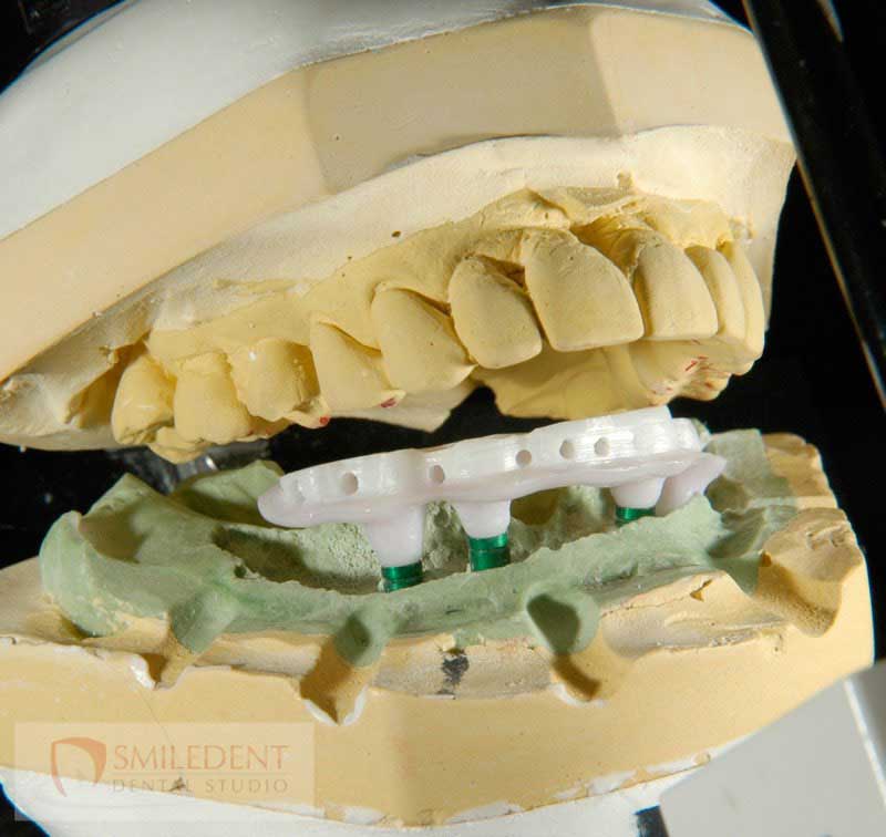 SmileDent Dental Studio | Prettau Bridge, Aesthetic E-Max Solutions and PFM AND FCM Solutions