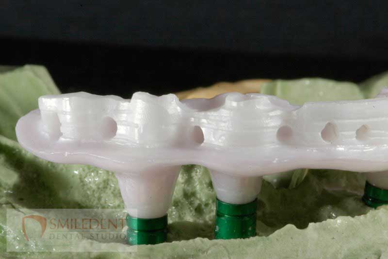 SmileDent Dental Studio | Acrylic Hybrid Solutions, CHROME trade  GuidedSMILE trade  and nSequence reg  Protocol 