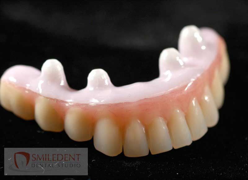 SmileDent Dental Studio | Prettau Bridge, CHROME trade  GuidedSMILE trade  and Implant Solutions
