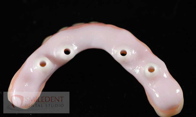 SmileDent Dental Studio | nSequence reg  Protocol , Implant Solutions and Surgical Guides