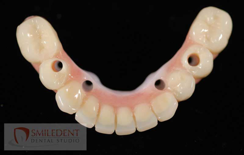 SmileDent Dental Studio | Surgical Guides, Prettau Bridge and Implant Solutions