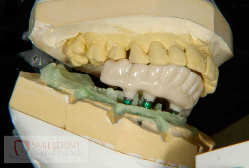 SmileDent Dental Studio | CHROME trade  GuidedSMILE trade , Acrylic Hybrid Solutions and nSequence reg  Protocol 