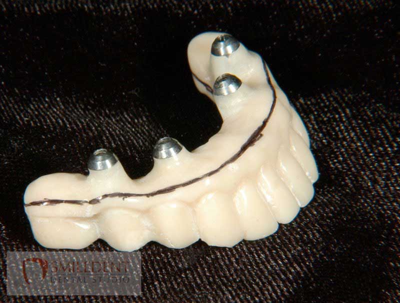 SmileDent Dental Studio | nSequence reg  Protocol , PFM AND FCM Solutions and Prettau Bridge