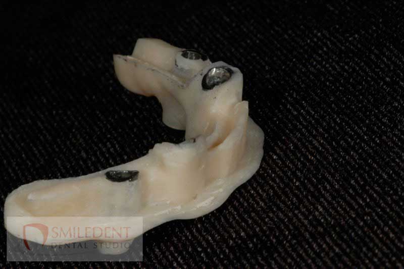 SmileDent Dental Studio | Acrylic Hybrid Solutions, Aesthetic E-Max Solutions and Implant Solutions