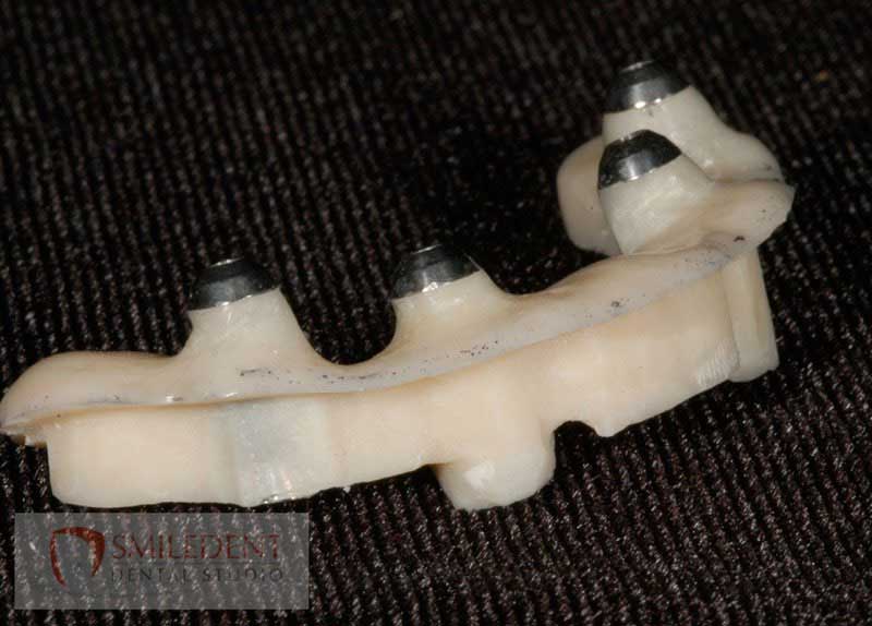 SmileDent Dental Studio | Zirconia, Aesthetic E-Max Solutions and Implant Solutions