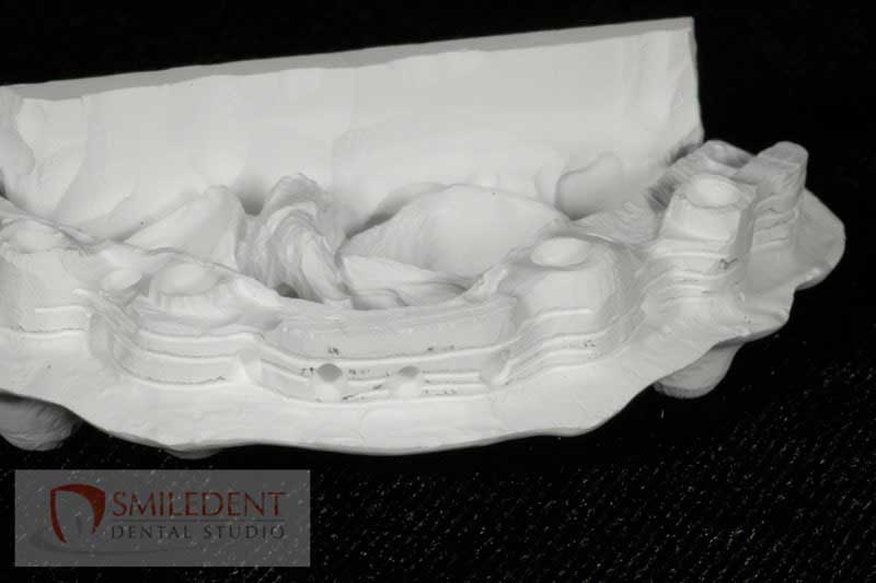 SmileDent Dental Studio | Implant Solutions, Surgical Guides and Aesthetic E-Max Solutions