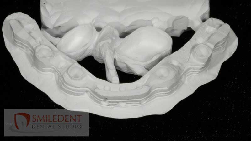 SmileDent Dental Studio | Implant Solutions, CHROME trade  GuidedSMILE trade  and Aesthetic E-Max Solutions