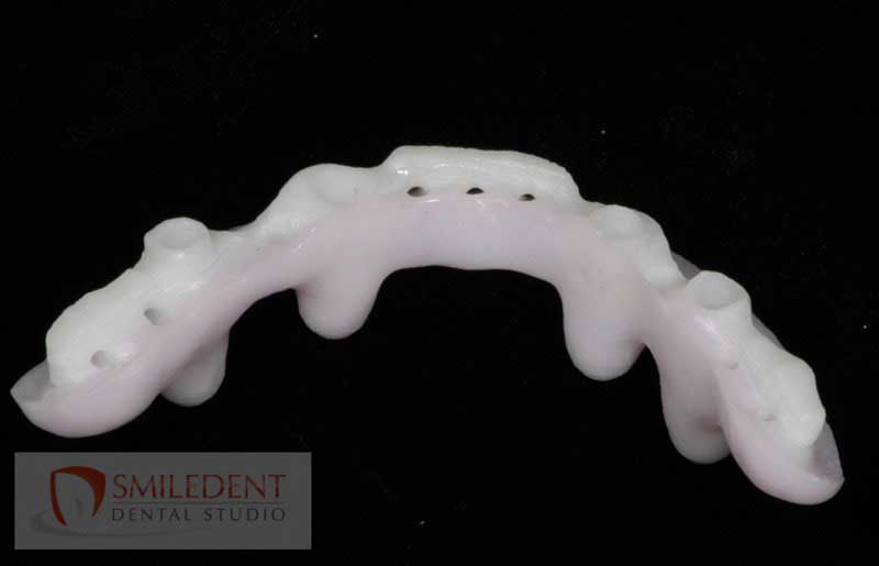 SmileDent Dental Studio | PFM AND FCM Solutions, Surgical Guides and Prettau Bridge
