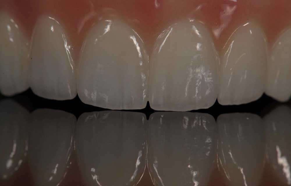 SmileDent Dental Studio | PFM AND FCM Solutions, Acrylic Hybrid Solutions and Prettau Bridge