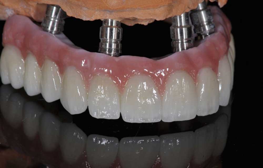 SmileDent Dental Studio | Implant Solutions, nSequence reg  Protocol  and Prettau Bridge