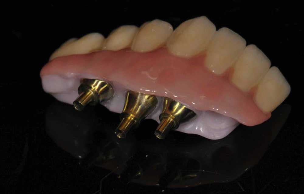 SmileDent Dental Studio | PFM AND FCM Solutions, nSequence reg  Protocol  and Zirconia