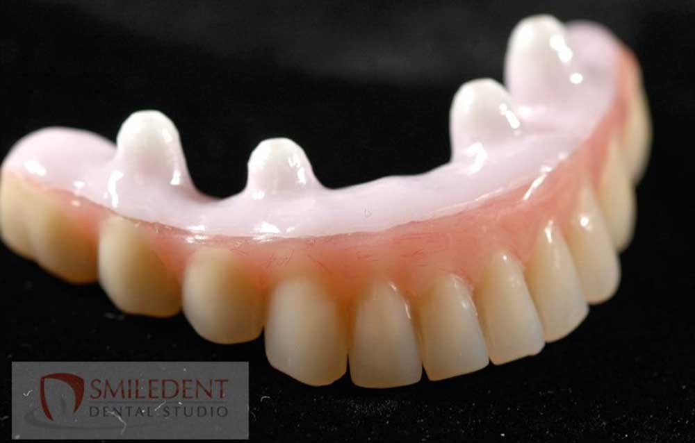 SmileDent Dental Studio | nSequence reg  Protocol , PFM AND FCM Solutions and Prettau Bridge