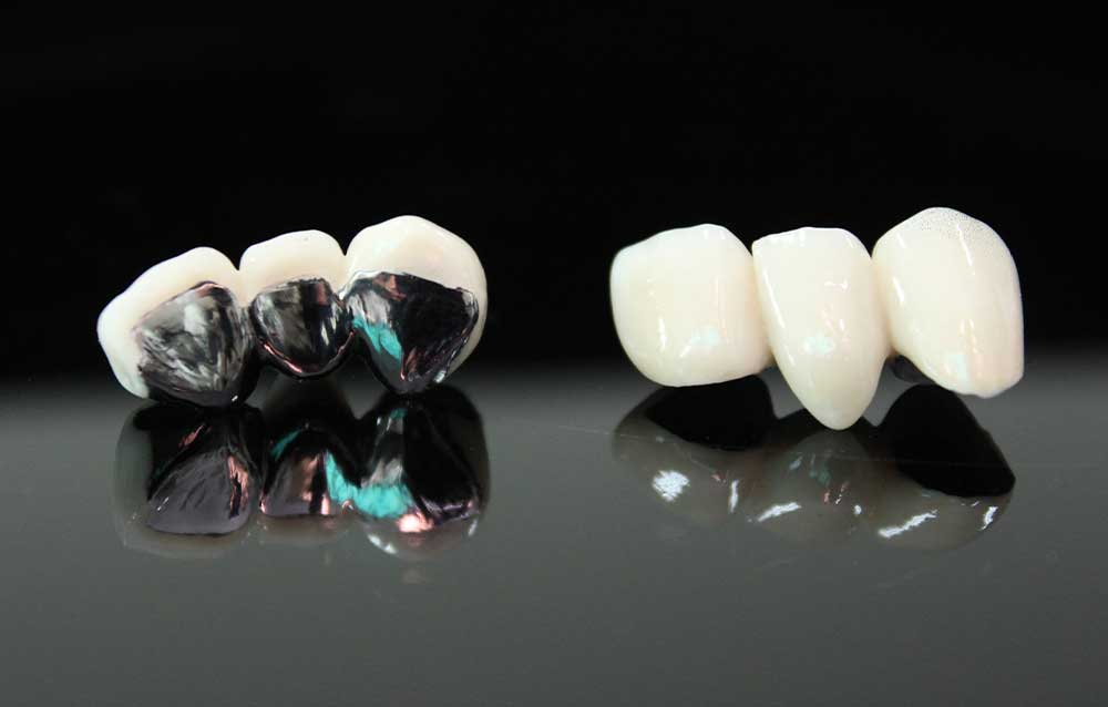 SmileDent Dental Studio | Zirconia, Aesthetic E-Max Solutions and Implant Solutions